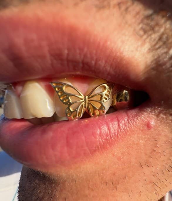 Gold open-wing butterfly grill on a front tooth