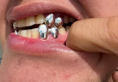 Polished silver caps on four teeth